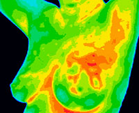 Using Thermography to Detect Breast Cancer Earlier