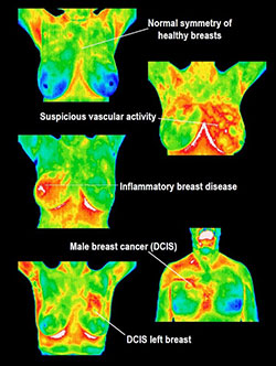 Using Thermography to Detect Breast Cancer Earlier