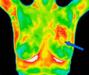 Using Thermography to Detect Breast Cancer Earlier