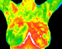 Using Thermography to Detect Breast Cancer Earlier