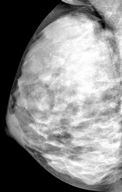 Using Thermography to Detect Breast Cancer Earlier